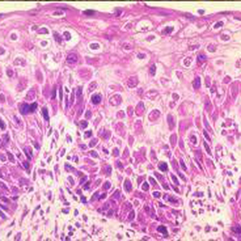 Lasso Diagnosticos. Biopsia de Cérvix. Infección por H.P.V.