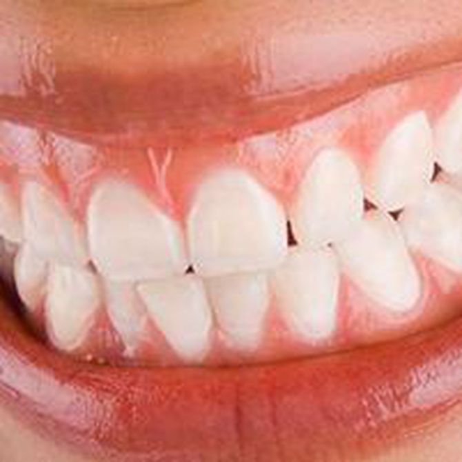 Recomendaciones para cuidar la estética dental
