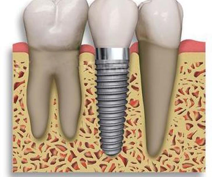 Implantes: Servicios de Clínica Dental El Carmen }}