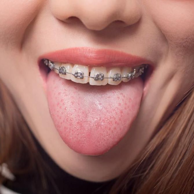 ¿Qué alimentos puedo comer durante la ortodoncia?