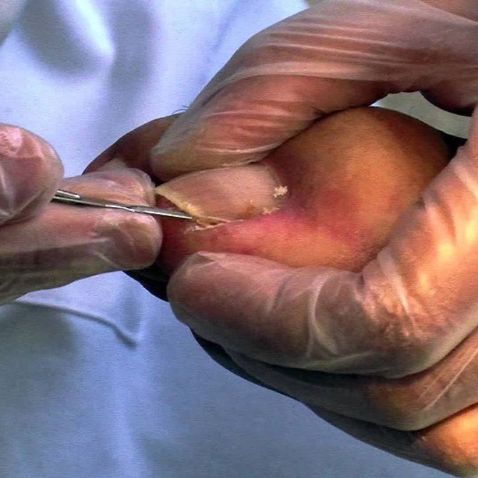 Causas y síntomas de las uñas encarnadas