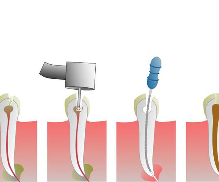 Endodoncia: Servicios de Clínica Dental Mas Camarena