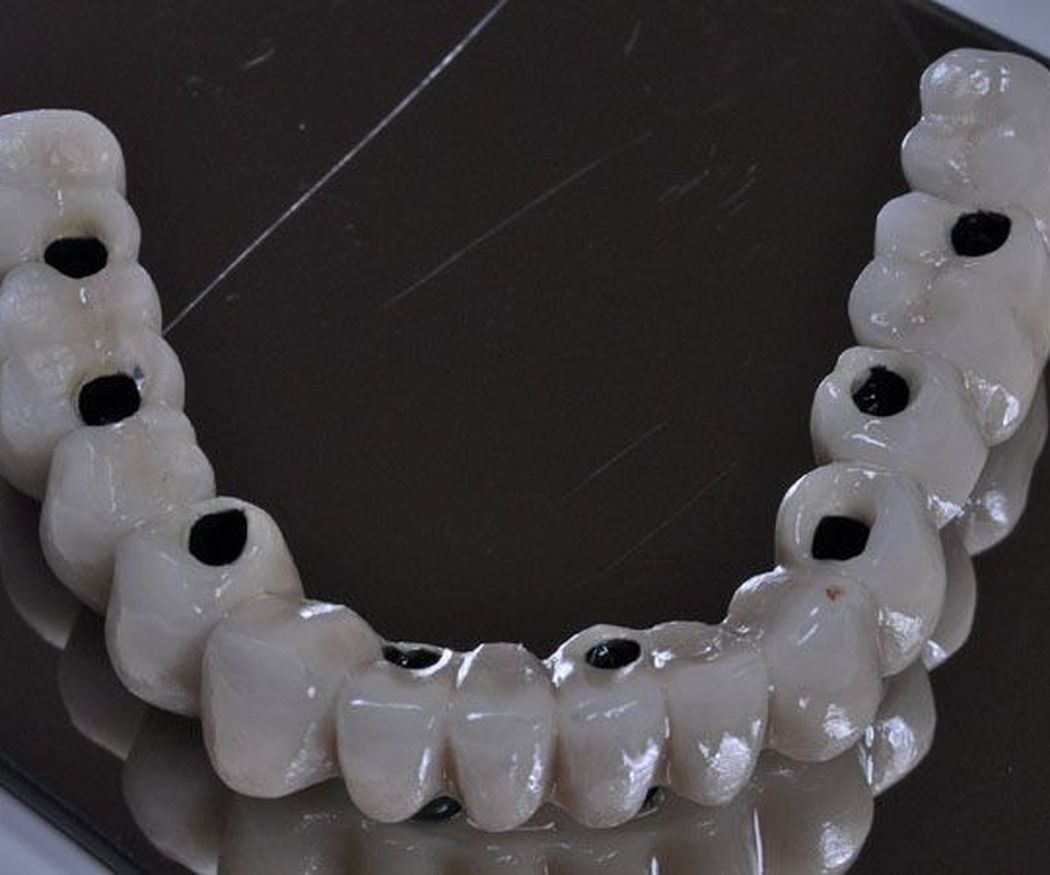 ¿Sabes en qué consisten los implantes dentales?