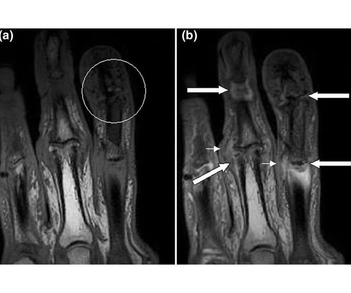 Artritis psoriásica: Tratamientos de Pacientes particulares