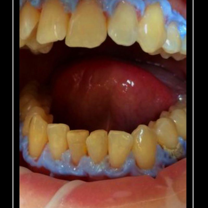 Blanqueamiento: Tratamientos de Clínica Dental Tucán