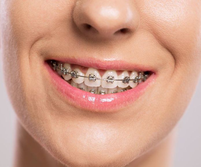Ortodoncia: NUESTROS TRATAMIENTOS de Clínica Dental Annie Duran
