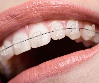 Brakets de autoligado pasivo: Ortodoncia de Isabel Perales Clínica Dental
