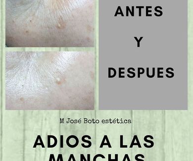 Eliminar manchas en la piel