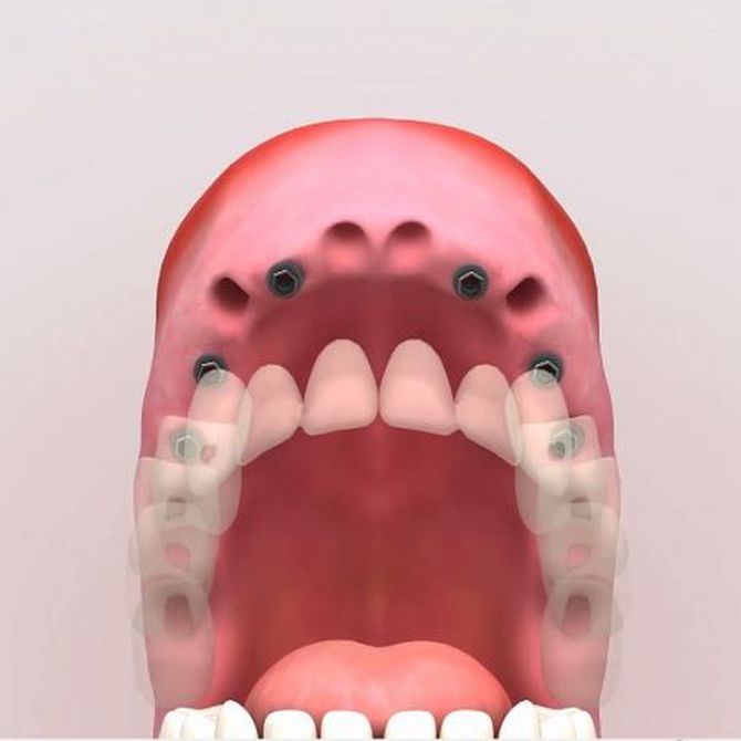 Descubre las ventajas que ofrecen los implantes dentales