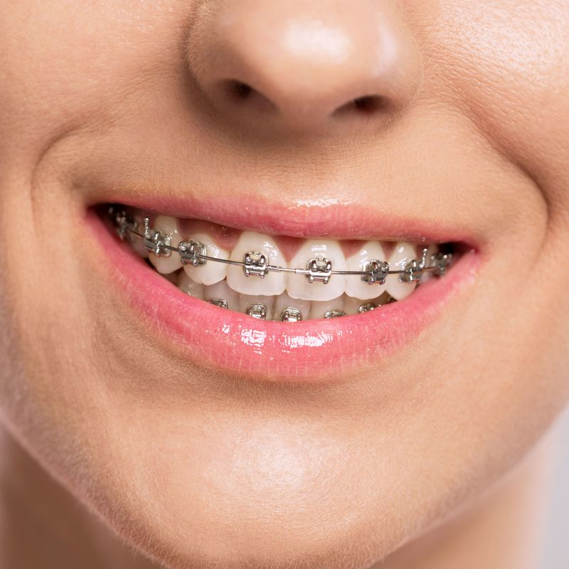 Brackets metálicos: Ortodoncia de Isabel Perales Clínica Dental
