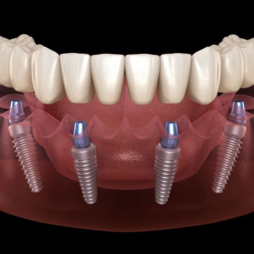 Implantes dentales en Madrid centro