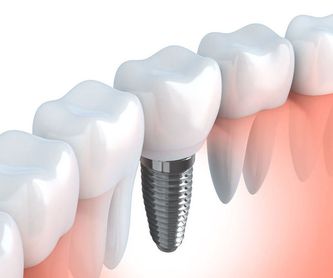 Ortodoncia dental fija (brackets): Tratamientos de Clínica Dental Dra. Carretero