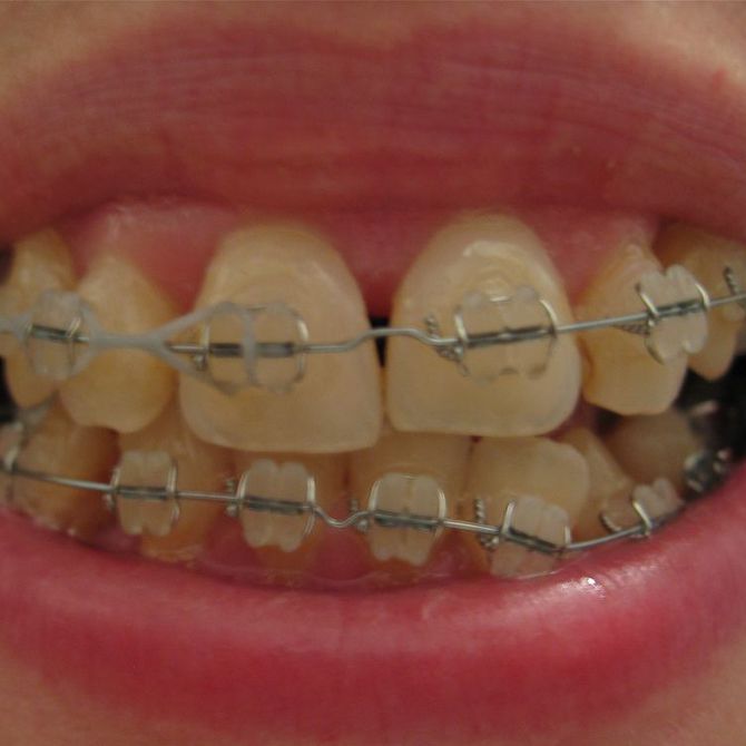 Las diferencias entre la ortodoncia invisible y los brackets metálicos