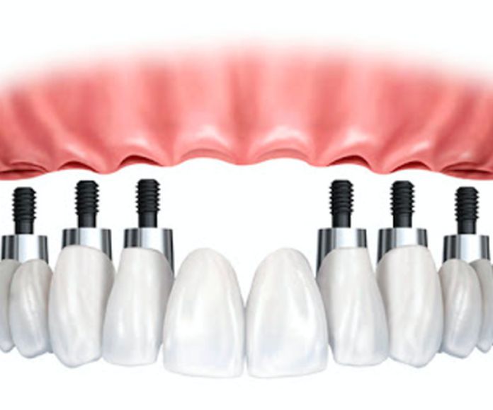 Implantes Dentales: Tratamientos de CLIESDENT - Clínica de Especialistas Dentales