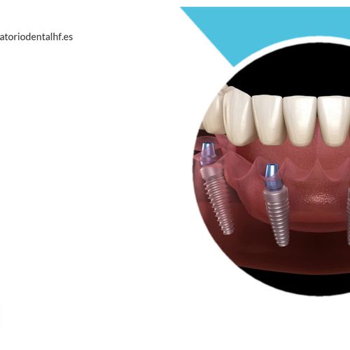 Prótesis dentales en Madrid centro | Laboratorio HF