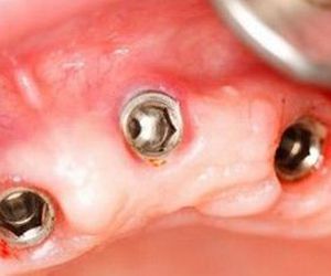 Prótesis Dental