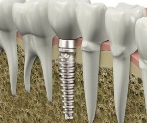 Implantes dentales 