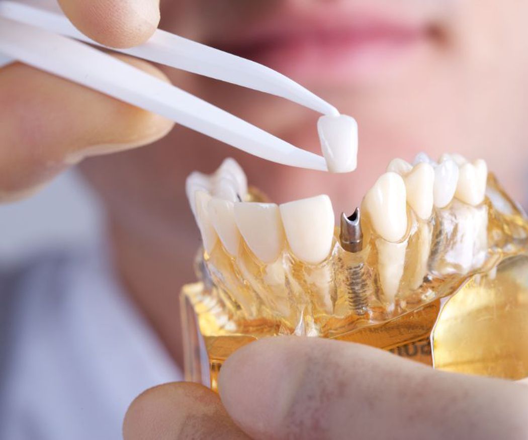 Ventajas de los implantes dentales