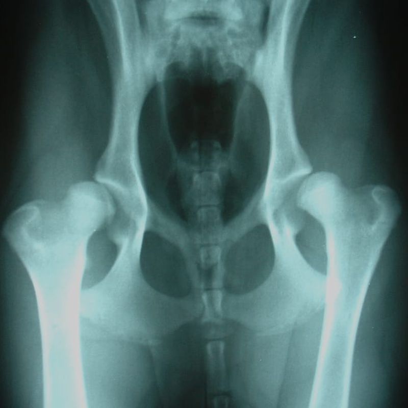 Radiografía diagnóstico displasia cadera