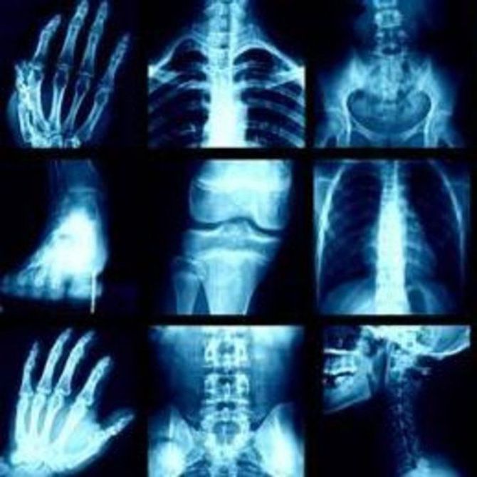 Algunos mitos relacionados con los rayos X
