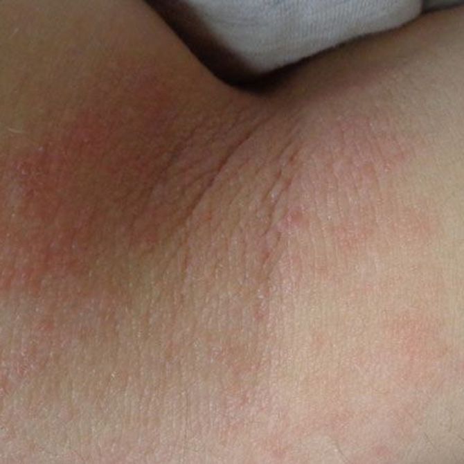 ¿Qué es la dermatitis atópica?