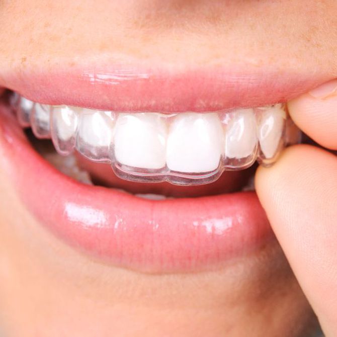 ¿Cuáles son las ventajas de las ortodoncias invisibles?