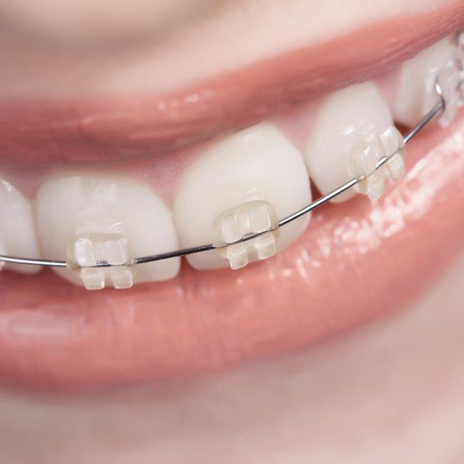 La fase de retención de la ortodoncia