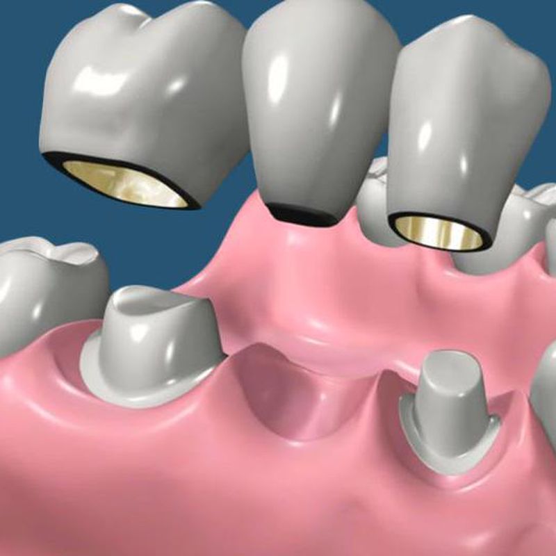 Protesis fija: Tratamientos de Hospident Clínica Dental