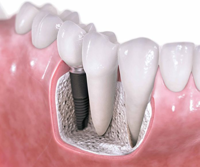 IMPLANTES: ESPECIALIDADES de Clínica Dental Morey