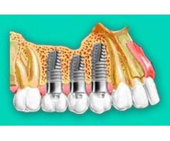 Cirugía e implantes: Tratamientos de Clínica Dental Xixón }}