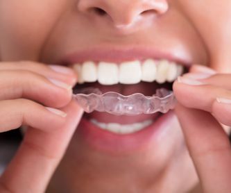 Estética dental: Tratamientos de Clínica Dental Santa Marta
