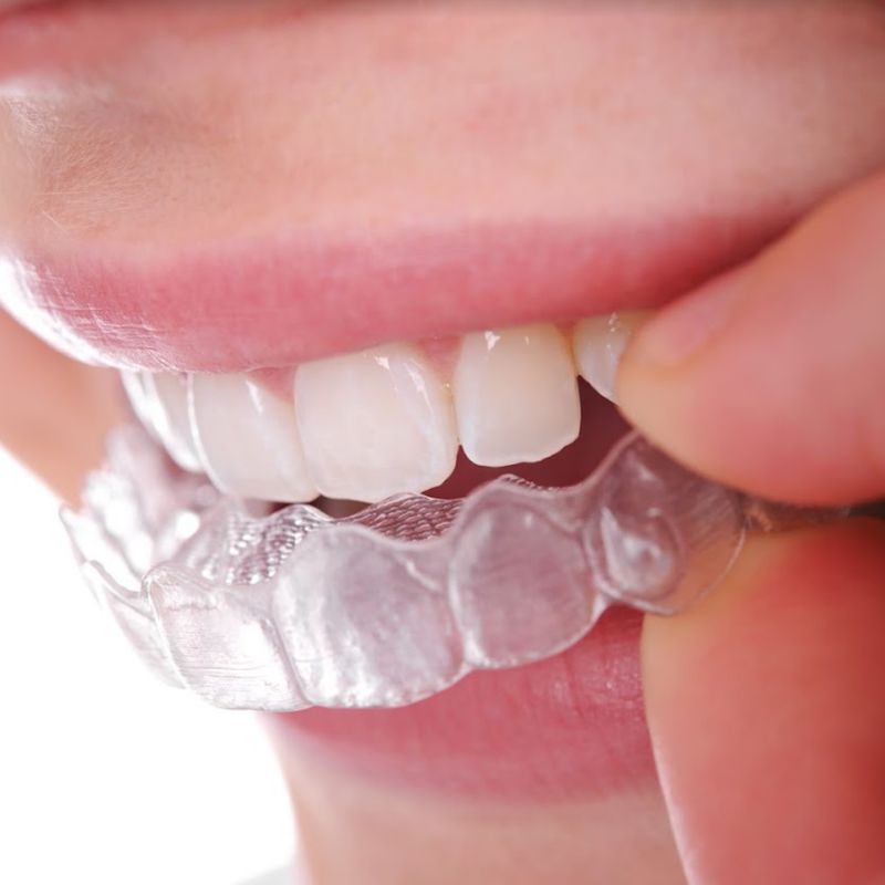 Ortodoncia invisible: SERVICIOS de Altes Dental