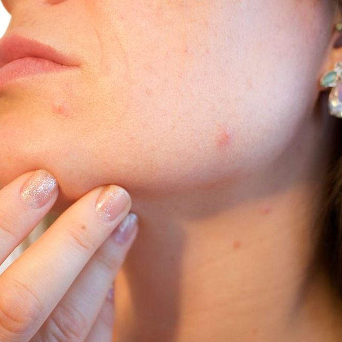 ¿Sabes por qué aparece el acné?