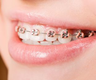Consejos para disminuir las molestias de la ortodoncia