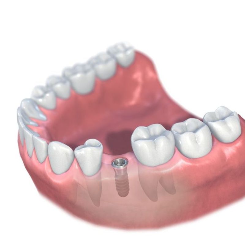 Implantes: Tratamientos de Clínica Dental Tucán