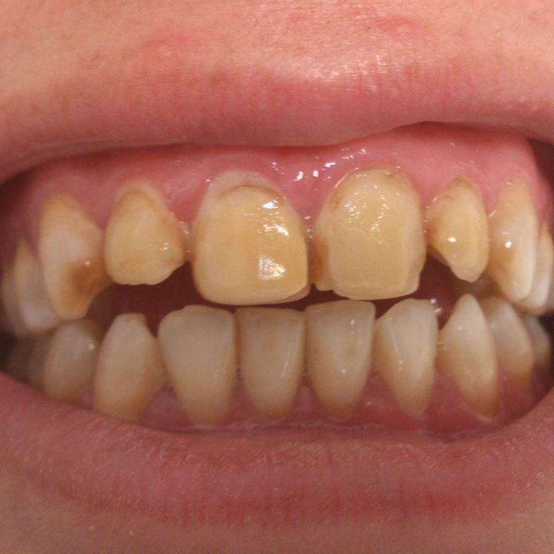 Carillas porcelana: Tratamientos de Clínica Dental Tucán
