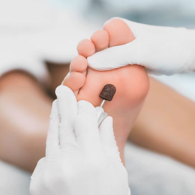 Cómo eliminar los hongos en los pies a través de cirugía