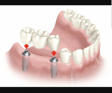 Especializados en implantes dentales 
