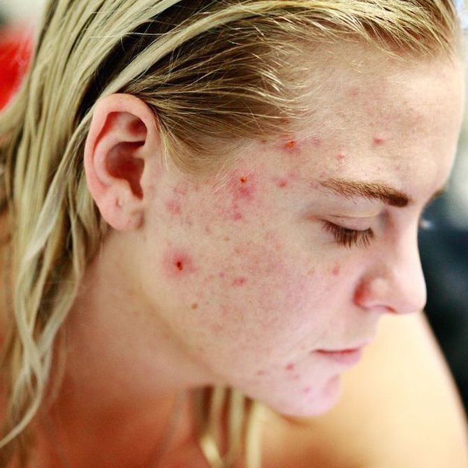¿Sabes cuáles son las causas del acné?
