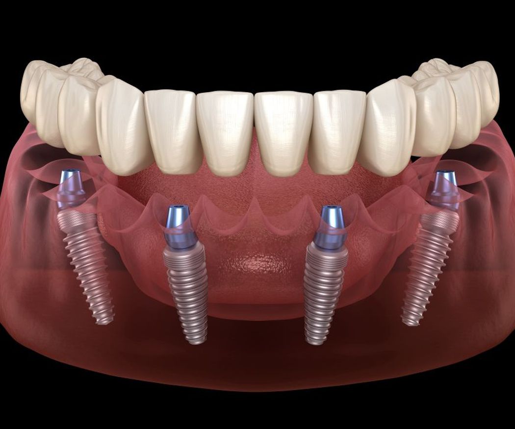 Ventajas de los implantes dentales