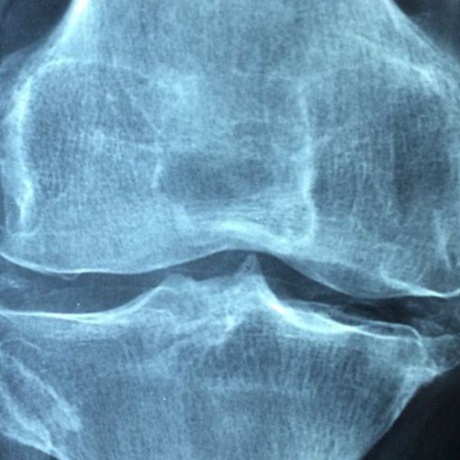 ¿Qué factores influyen en el desarrollo de la osteoporosis?