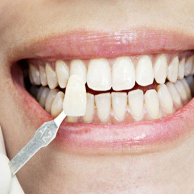 Las carillas dentales mejoran el aspecto de tu sonrisa