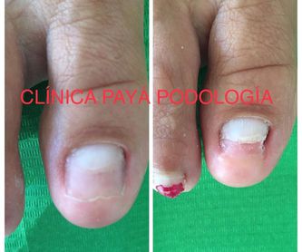 Biomecánica y ortopodología: Tratamientos de Clínica Payá Podología