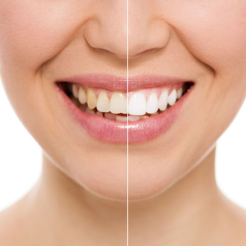Blanqueamiento dentario: Tratamientos y Servicios de Clínica Dental Censadent