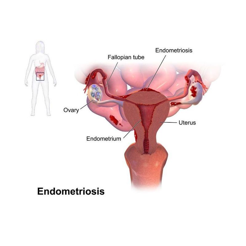 Endometriosis: Nuestros Tratamientos de HOSPITAL RECOLETAS DE SEGOVIA