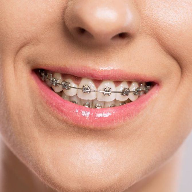 ¿Qué molestias pueden aparecer por culpa de una ortodoncia?