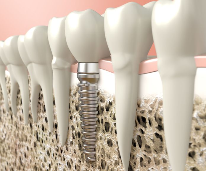 Implantes dentales: Tratamientos de Trabajamos con las principales mutuas y aseguradoras de salud