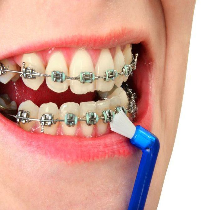 Qué son los microimplantes dentales