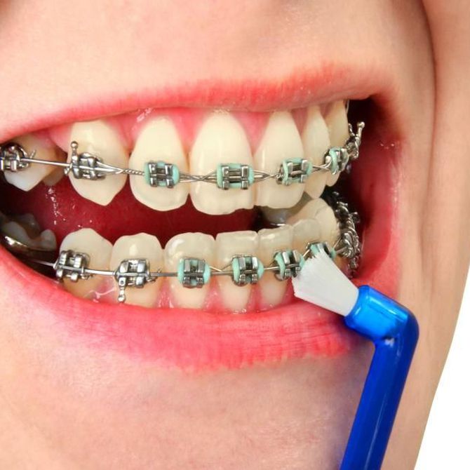 Claves para la higiene bucal cuando llevas ortodoncia
