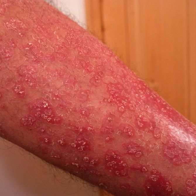 ¿Qué es la dermatitis atópica? ¿Cómo tratarla?